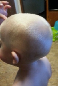 Back of boy's head after haircut due to lice.